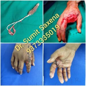 Index Finger Reimplantation