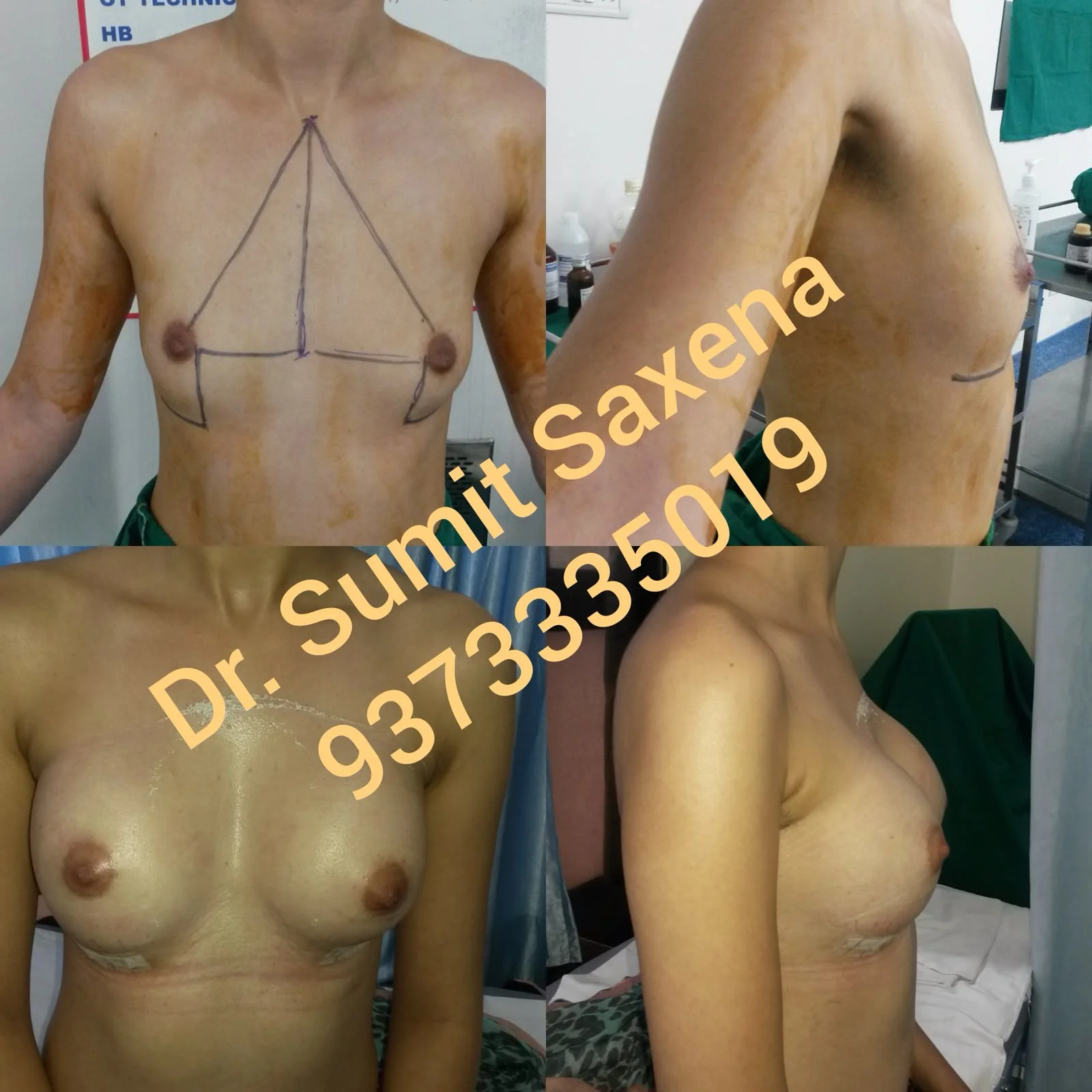 Gynecomastia