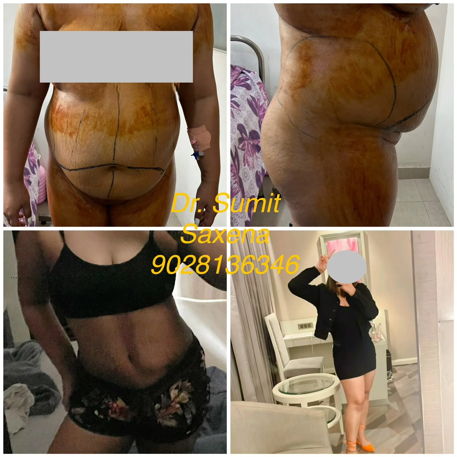 Liposuction