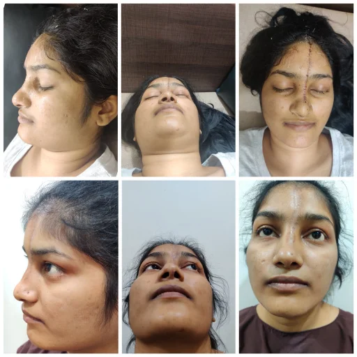 Facial Feminisation
