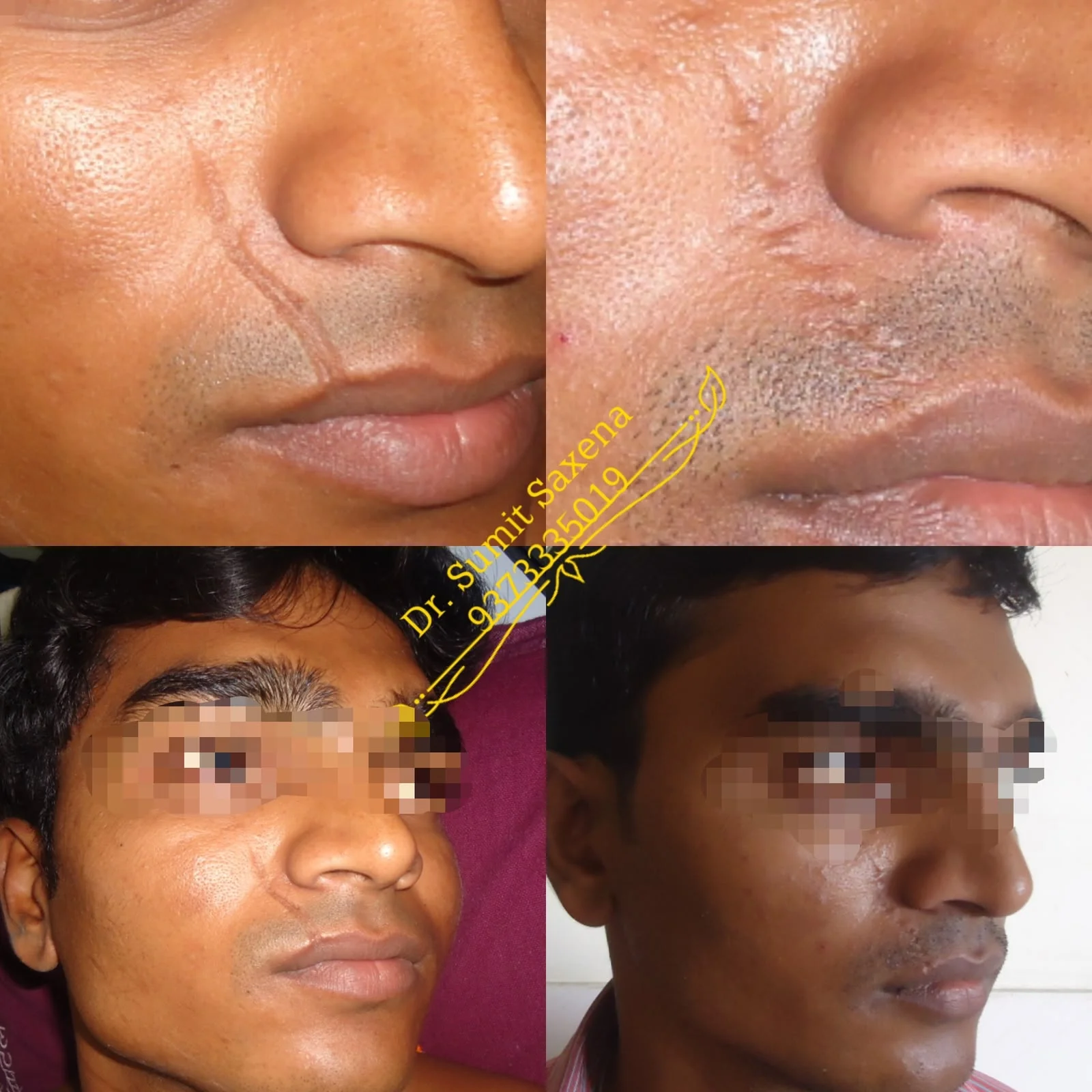 Rhinoplasty Surgery