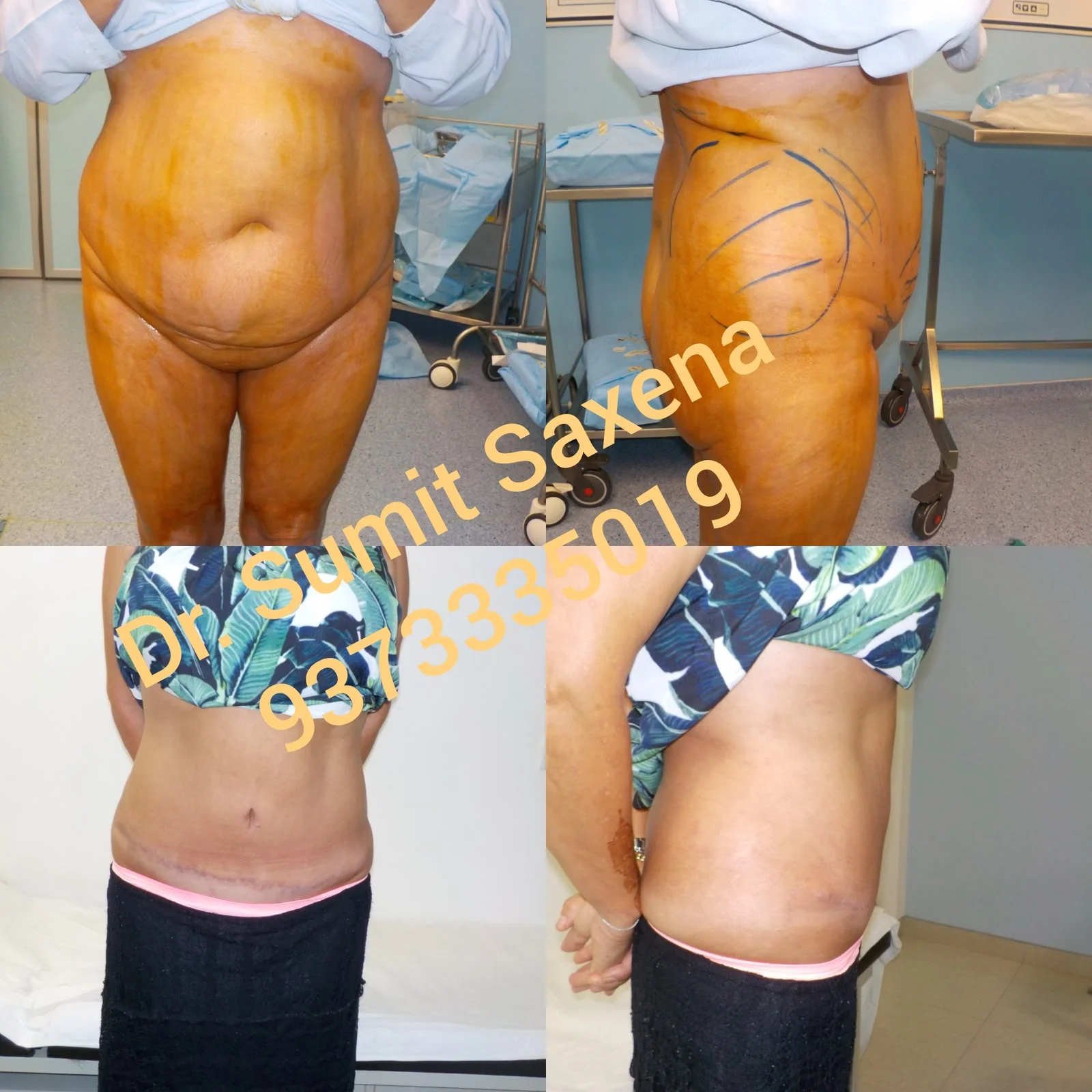 Tummy Tuck
